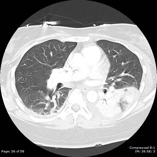 Bilateral pulmonary emboli with Hampton hump sign (Radiopaedia 54070-60246 Axial lung window 36).jpg