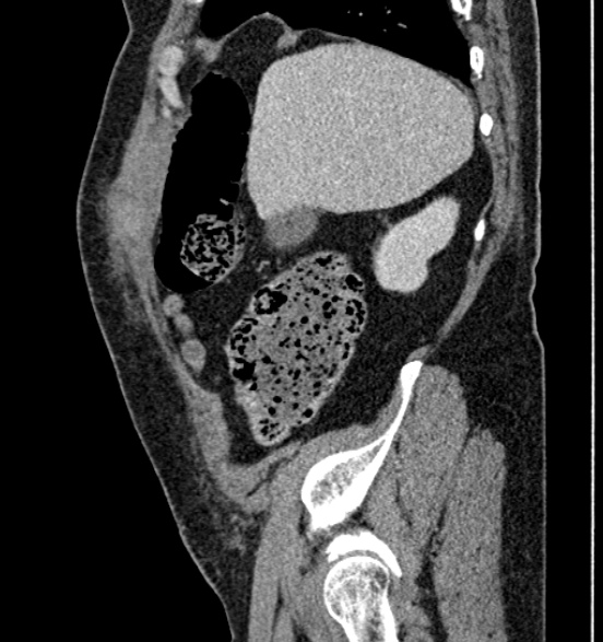Bilateral rectus sheath hematomas (Radiopaedia 50778-56252 B 19).jpg
