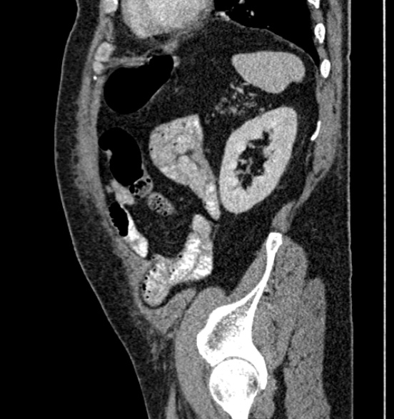 Bilateral rectus sheath hematomas (Radiopaedia 50778-56252 B 62).jpg