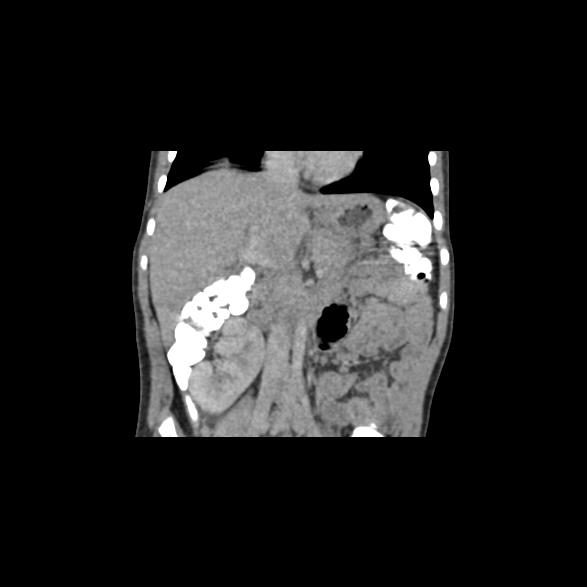 File:Bilateral renal malrotation (Radiopaedia 30901-31606 B 35).jpg
