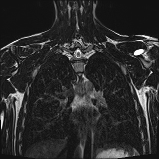Bilateral spinoglenoid notch ganglion cysts (Radiopaedia 29577-30082 Coronal T2 83).jpg