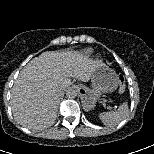 Bilateral staghorn calculi (Radiopaedia 59475-66842 Axial non-contrast 1).jpg