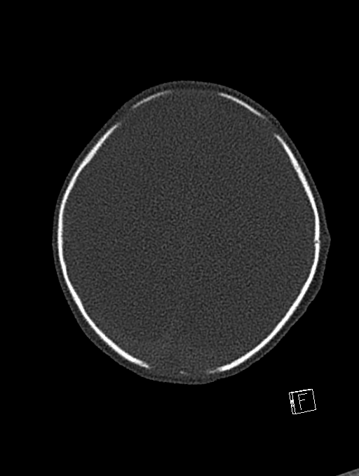 Bilateral subdural hemorrhage and parietal skull fracture (Radiopaedia 26058-26192 Axial bone window 28).png