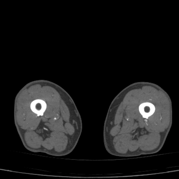 Bilateral superficial femoral arterial occlusion (Radiopaedia 25682-25857 A 46).jpg