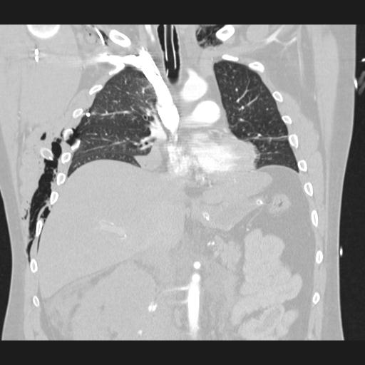 Bilateral traumatic renovascular injury (Radiopaedia 32051-32995 Coronal lung window 39).jpg