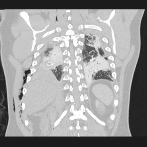 Bilateral traumatic renovascular injury (Radiopaedia 32051-32995 Coronal lung window 64).jpg