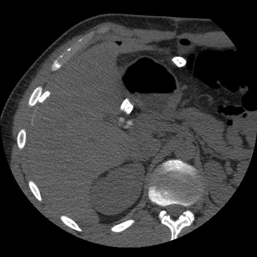 File:Bile leak from liver traumatic laceration (Radiopaedia 63463-72077 Axial Biliscopin 42).jpg