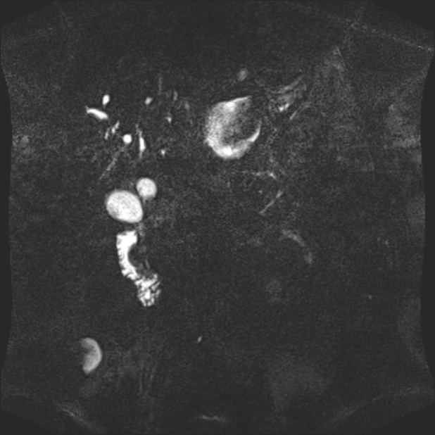 Biliary pancreatitis (Radiopaedia 72289-82824 Coronal 3D T2 62).jpg