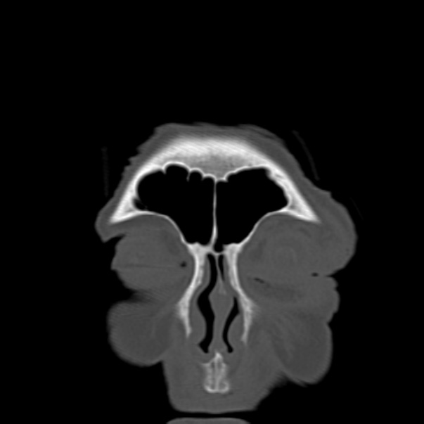 Biparietal osteodystrophy (Radiopaedia 46109-50463 Coronal bone window 16).jpg