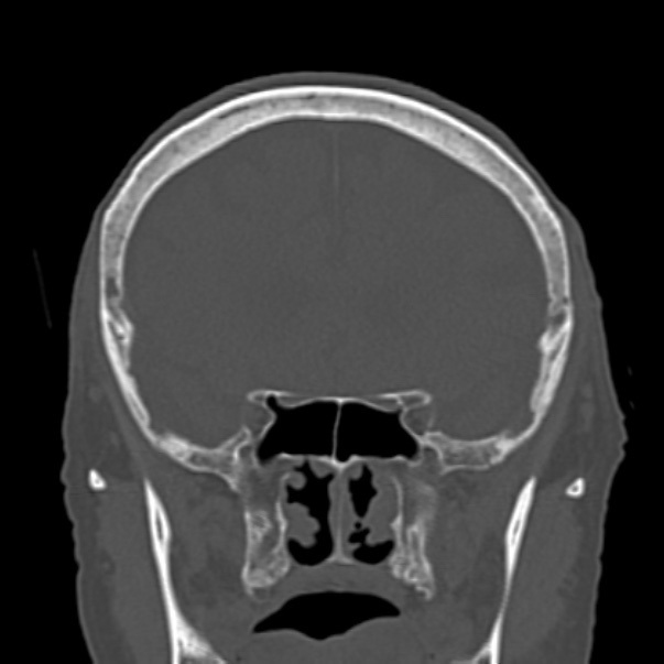 Biparietal osteodystrophy (Radiopaedia 46109-50463 Coronal bone window 40).jpg