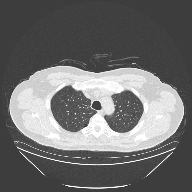 Birt-Hogg-Dubé syndrome (Radiopaedia 52578-58491 Axial lung window 13).jpg