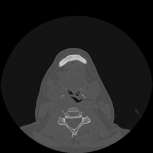 File:Bisphosphonate-related osteonecrosis of the jaw (Radiopaedia 71324-81642 Axial bone window 15).jpg