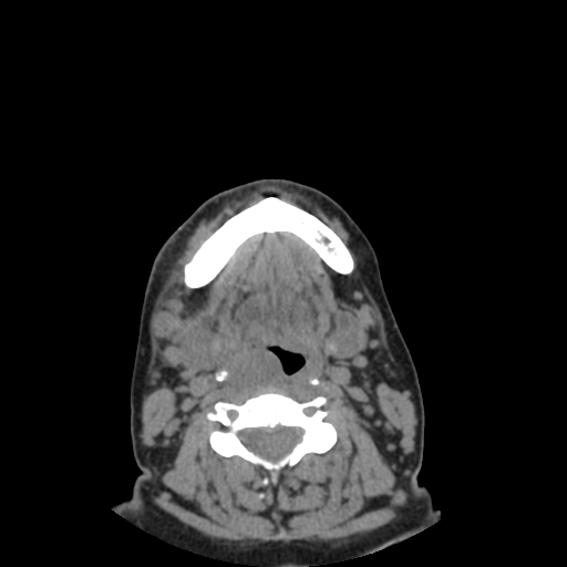 Bisphosphonate-related osteonecrosis of the jaw (Radiopaedia 71324-81642 non-contrast 29).jpg