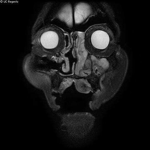 File:Bisphosphonate-related osteonecrosis of the maxilla (Radiopaedia 51367-57101 Coronal T2 fat sat 26).jpg