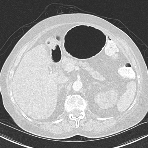 File:Bladder and bowel cancers (Radiopaedia 37688-39592 Axial lung window 54).png