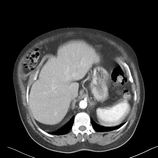 File:Bladder papillary urothelial carcinoma (Radiopaedia 48119-52951 A 7).png