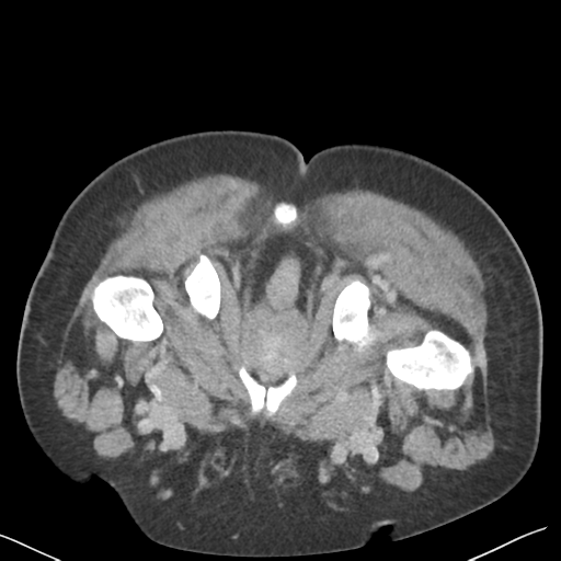 File:Bladder papillary urothelial carcinoma (Radiopaedia 48119-52951 Axial C+ delayed 62).png