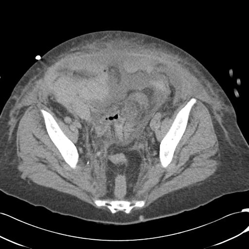 File:Bladder rupture post renal biopsy (Radiopaedia 30863-31572 Axial non-contrast 72).jpg