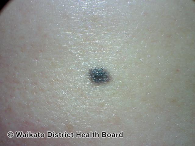 File:Blue naevus (DermNet NZ melanocytic-naevus-small-16).jpg