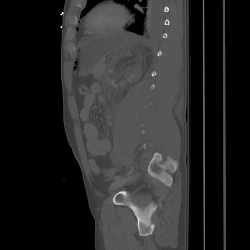 Blunt abdominal trauma with solid organ and musculoskelatal injury with active extravasation (Radiopaedia 68364-77895 Sagittal bone window 69).jpg