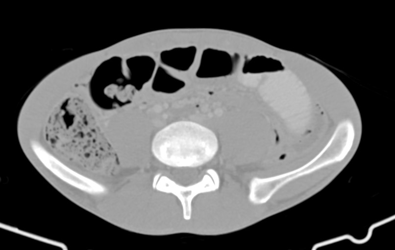 Blunt injury to the small bowel (Radiopaedia 74953-85987 Axial Wide 62).jpg