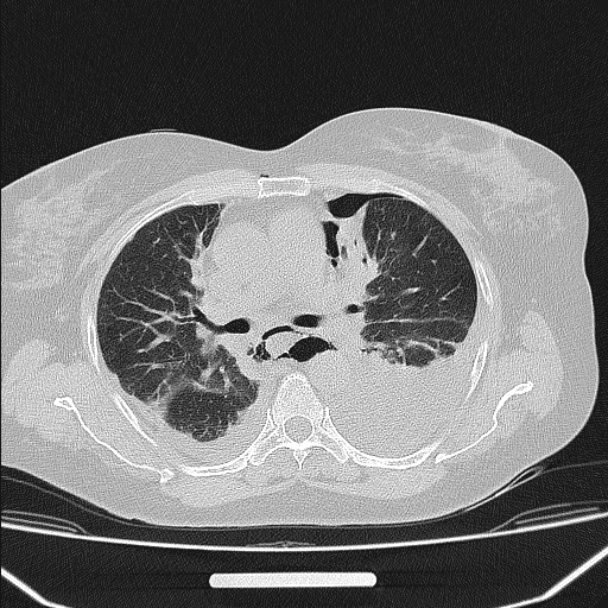 Boerhaave syndrome (Radiopaedia 45644-49799 Axial lung window 57).jpg