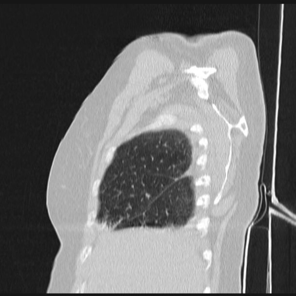 Boerhaave syndrome (Radiopaedia 45644-49799 Sagittal lung window 10).jpg
