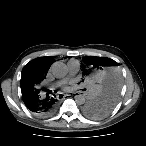 File:Boerhaave syndrome (Radiopaedia 59796-67310 Axial liver window 33).jpg