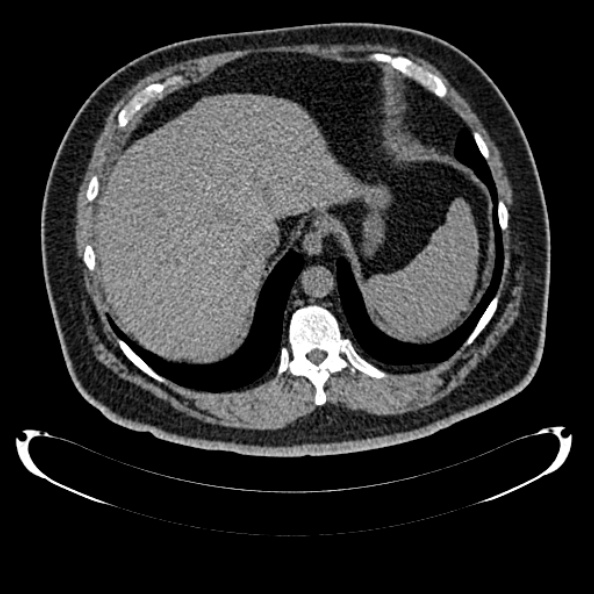 Bosniak renal cyst - type IV (Radiopaedia 24244-24518 Axial non-contrast 61).jpg