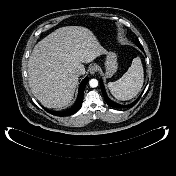 Bosniak renal cyst - type IV (Radiopaedia 24244-24518 B 47).jpg