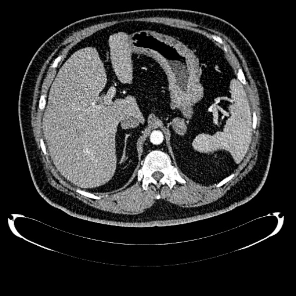 Bosniak renal cyst - type IV (Radiopaedia 24244-24518 B 74).jpg