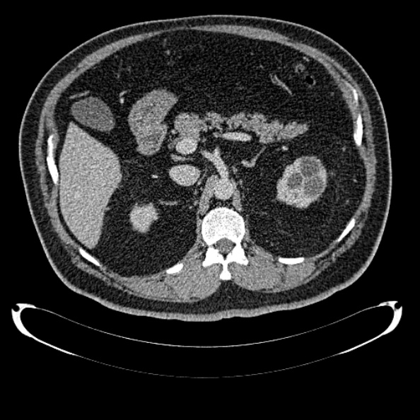 File:Bosniak renal cyst - type IV (Radiopaedia 24244-24518 C 108).jpg