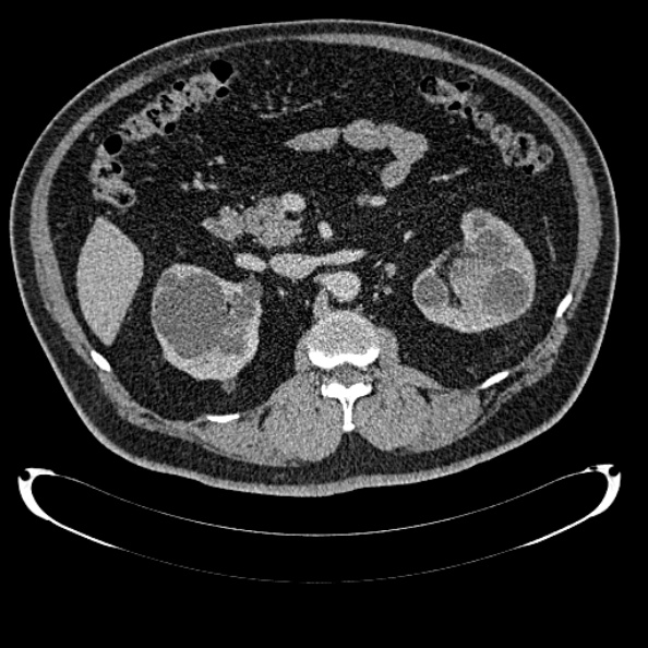 Bosniak renal cyst - type IV (Radiopaedia 24244-24518 C 133).jpg