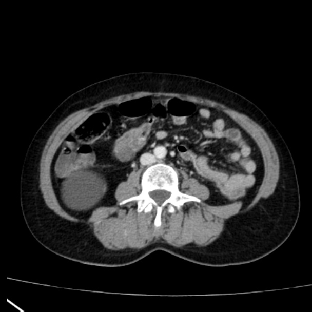 Bosniak renal cyst - type I (Radiopaedia 27479-27675 C 51).jpg