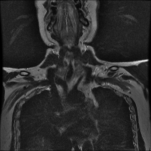 File:Brachial plexus neurofibroma (Radiopaedia 28030-28291 Coronal T2 12).png