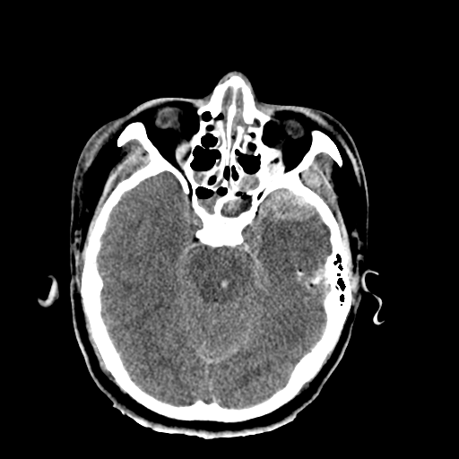 File:Brain contusions, internal carotid artery dissection and base of skull fracture (Radiopaedia 34089-35339 Axial non-contrast 24).png