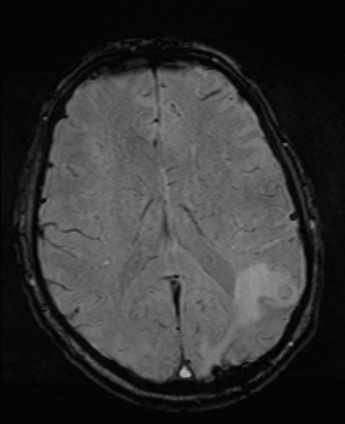 Brain metastases - lung cancer primary (Radiopaedia 75060-86115 Axial SWI 36).jpg