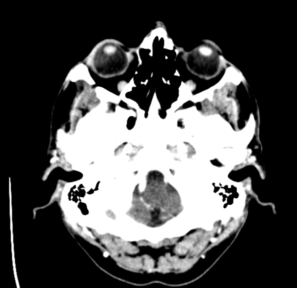 File:Brain metastases from lung cancer (Radiopaedia 24480-24781 Axial C+ delayed 4).jpg