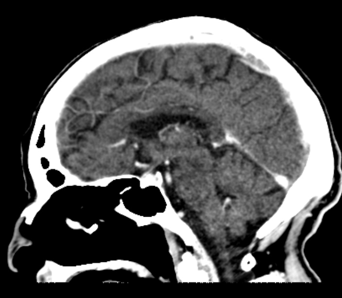 Brain metastases from lung cancer (Radiopaedia 27849-28092 Sagittal C+ delayed 33).jpg