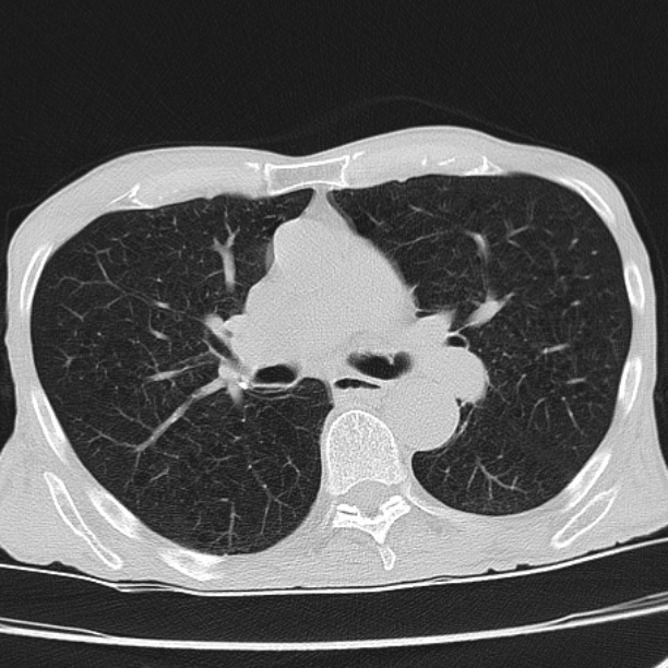 Brain metastases from lung cancer (Radiopaedia 27849-28093 Axial lung window 29).jpg