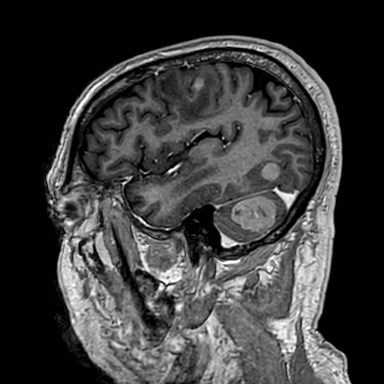 Brain metastases from lung cancer (Radiopaedia 83839-99028 Sagittal T1 C+ 51).jpg