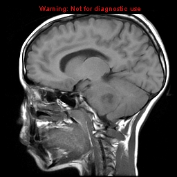 File:Brainstem glioma (Radiopaedia 9444-10124 Sagittal T1 7).jpg