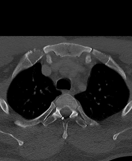 Branchial cleft cyst (Radiopaedia 31167-31875 Axial bone window 79).jpg