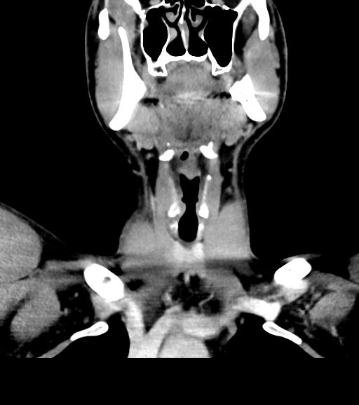 Branchial cleft cyst (Radiopaedia 31167-31875 Coronal C+ delayed 25).jpg