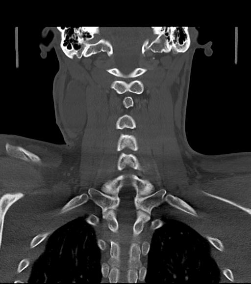 Branchial cleft cyst (Radiopaedia 31167-31875 Coronal bone window 46).jpg