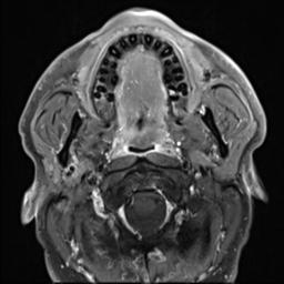 File:Branchial cleft cyst (Radiopaedia 31167-31876 Axial T1 C+ fat sat 23).jpg