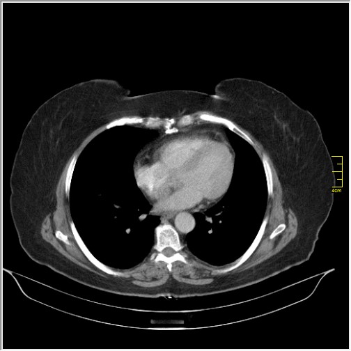 Breast cancer on thorax CT (Radiopaedia 60571-68275 A 65).JPG