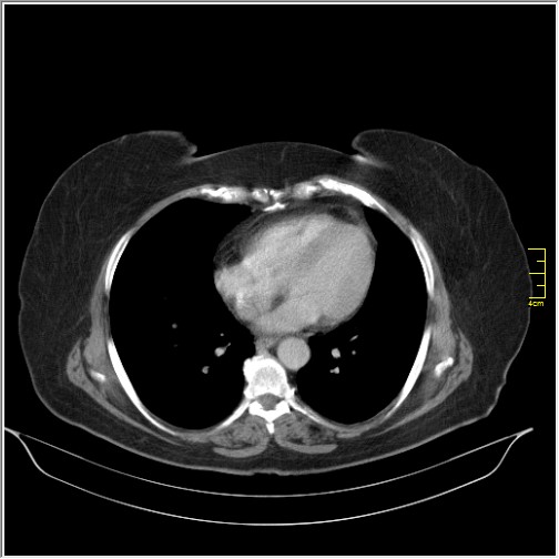 Breast cancer on thorax CT (Radiopaedia 60571-68275 A 68).JPG