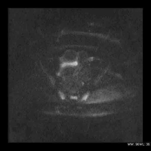 File:Broad ligament fibroid (Radiopaedia 49135-54241 Axial DWI 18).jpg