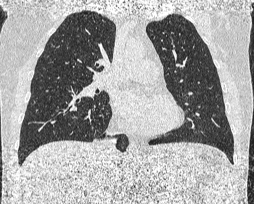 Bronchial atresia (Radiopaedia 58271-65417 Coronal lung window 24).jpg
